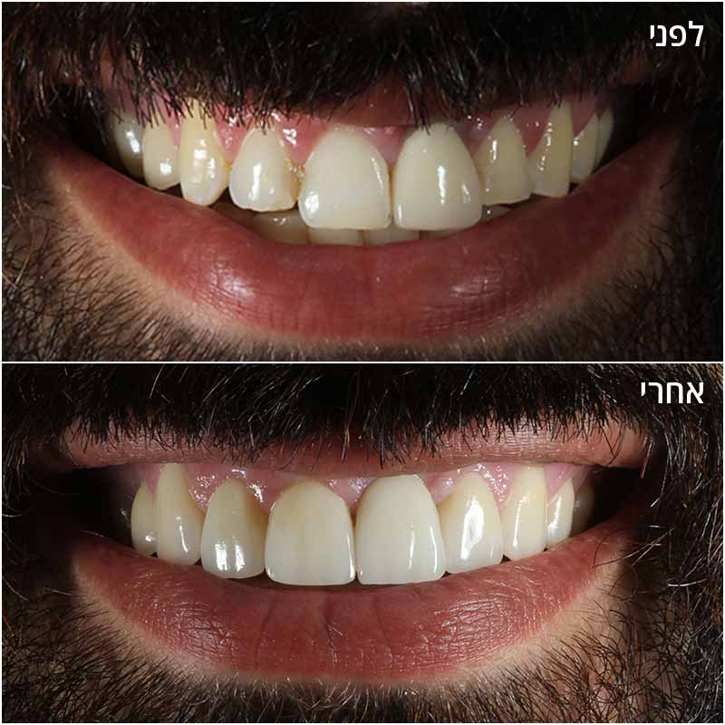 Before-After_Omri_07