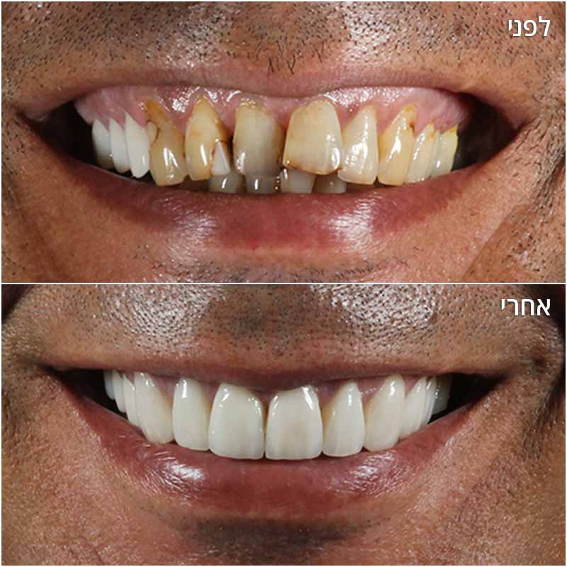 Before-After_Yaniv_05