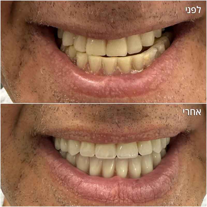 Before-After_40